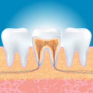 Воспаление корня зуба: лечение