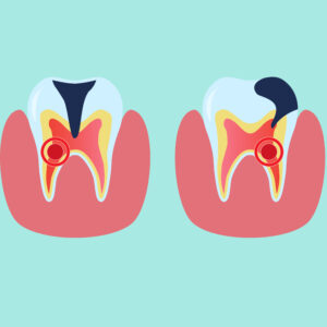 Пульпит зуба: симптомы, лечение