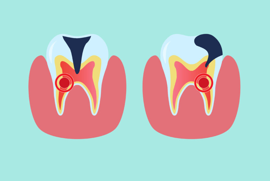Пульпит зуба: симптомы, лечение